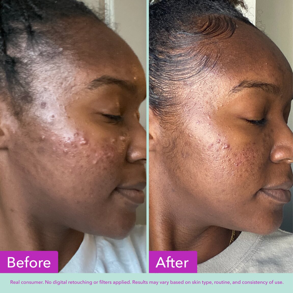 acne-foaming-cleanser-z5 zb_p.jpg